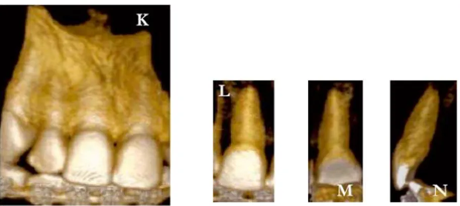 Figura G13 – Reconstrução tridimensional da vista vestibular da região do  dente 11 em K e em L a vista vestibular, M a vista palatina e  N a vista mesial do dente 11