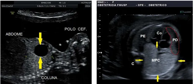 Figura  1  -  Corte  longitudinal  do  tórax  fetal.  Gestação  de  21  semanas  e  1  dia