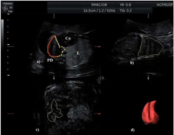 Figura 3 -   Imagem  tridimensional  do  tórax  fetal  com  lesão  pulmonar  congênita  (lesão  sólida  ecogênica  no  pulmão  esquerdo)  obtida  nos  três  planos  ortogonais:  a)  plano  transversal  ou  axial,  (Co)  coração  fetal,  (L)  lesão  pulmona