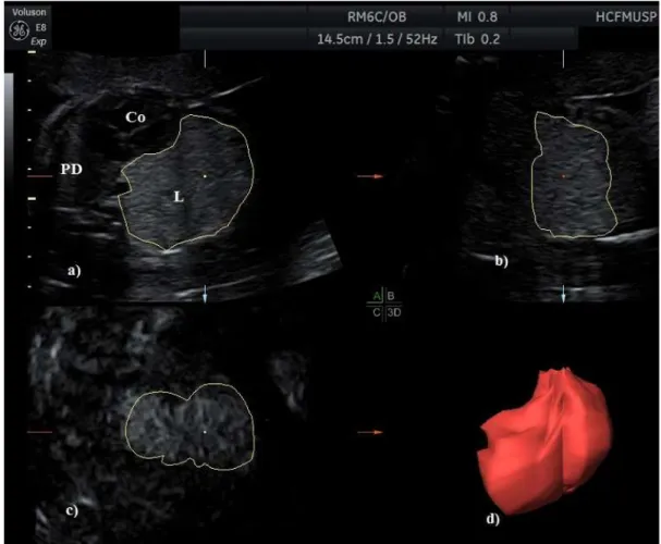 Figura 4 -   Imagem  tridimensional  do  tórax  fetal  com  lesão  pulmonar  congênita  (lesão  sólida  ecogênica  no  pulmão  esquerdo)  obtida  nos  três  planos  ortogonais:  a)  plano  transversal  ou  axial,  (Co)  coração  fetal,  (L)  lesão  pulmona