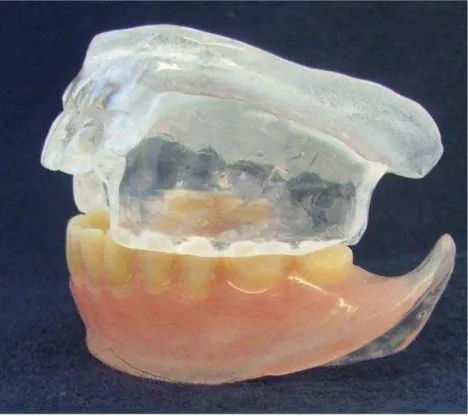 Figura 4.2 - Dispositivo intraoral (DIO) idealizado por Chaccur (2010) 