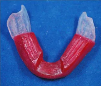 Figura 4.10 -  Ranhuras  bilaterais  e  abertura  anterior no plano mandibular 