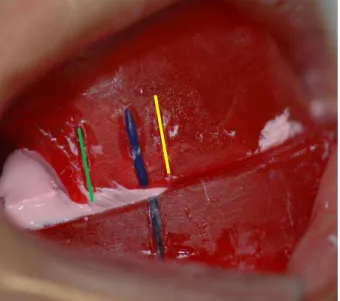 Figura 4.11 -  Fixação  do  avanço  mandibular  utilizando pasta zincoeugenólica 