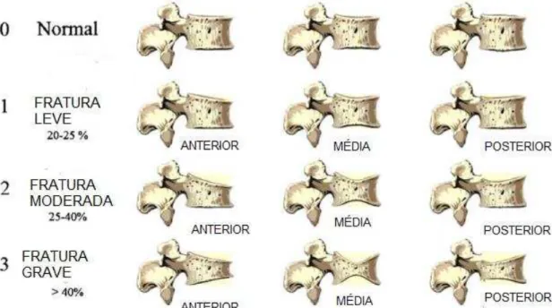Figura 9 - Classificação visual semiquantitativa de deformidades vertebrais.    