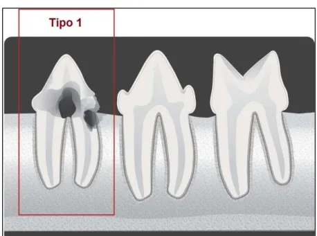 Figura 1 -  Ilustração da lesão de reabsorção dentária tipo 1 (T1) 
