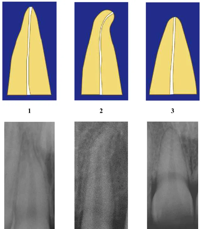 FIGURA 3 - Variáveis morfológicas do terço apical dentário: