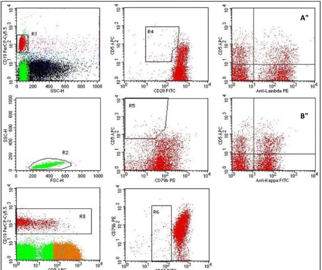 Figura 4. Imunofenotipagem normal. Demonstra as mesmas regiões descritas na figura anterior,  sem população bem definida de células B CD20 e CD79b de baixa expressão