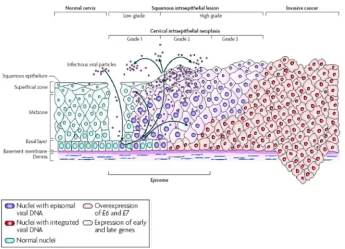 Figura 3: Progressão de câncer cervical mediado pelo HPV. Retirado de Woodman et al., 2007