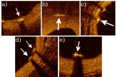 Figura 13 - Localizações de partes de stent de diferentes imagens