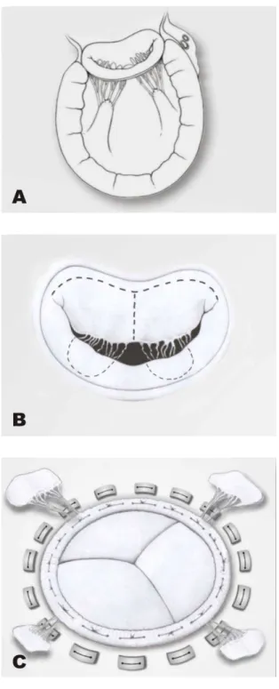 Figura 1 -   A) avaliação anatômica dos papilares; B) agrupamento das  cordas em 4 pilares; C) bioprótese implantada 