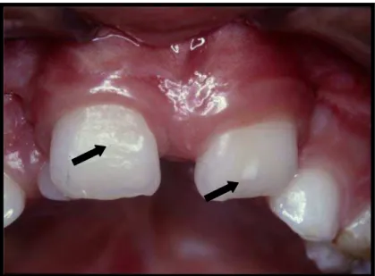 Figura 2 - Dente 11 (incisivo central superior direito permanente) com hipoplasia no  terço cervical e dente 21 (incisivo central superior esquerdo permanente) com opacidade  branca no terço médio 