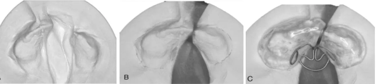 Figura 2 -  Ortopedia  ativa  proposta  por  Ishii  e  Oyama  -  placa  confeccionada  em  resina  acrílica  com fio de níquel titânio construída  em modelo previamente segmentado com intuito  de aproximação dos segmentos alveolares  
