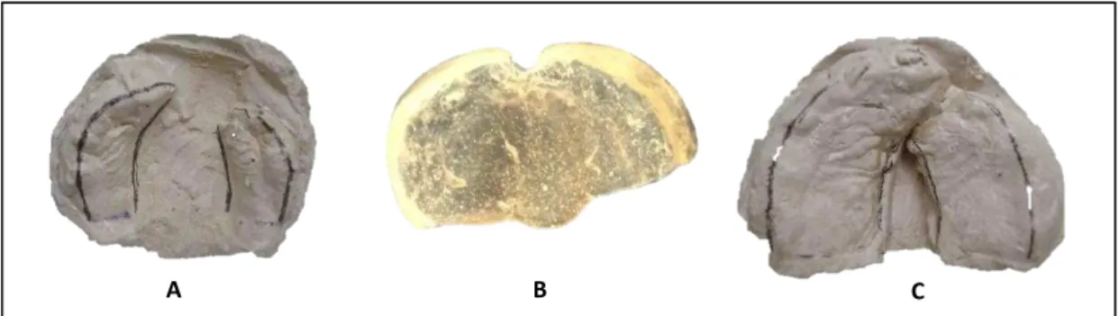 Figura 4 -  A: palato com fissura ampla unilateral completa; B: placa passiva; C: crescimento  ósseo no sentido medial, após 9 meses de uso da ortopedia 