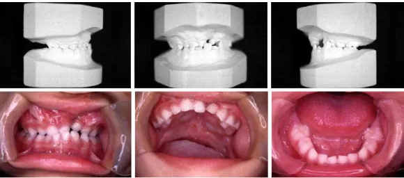 Figura 8 -   Fotografias intrabucais e modelos de um paciente com fissura labiopalatina  unilateral completa índice oclusal 3 