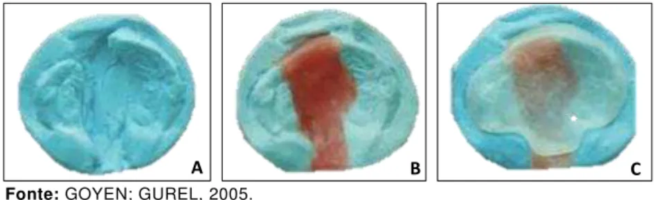 Figura 14 -  A:  modelo  de  gesso  de  maxila  de  recém-nascidos  com  FLPUC; B: preenchimento da região da fissura com cera; 