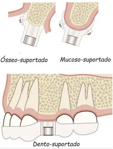 Figura 2.1 - Desenho esquemático mostrando os tipos de tecido de suporte dos guias cirúrgicos 