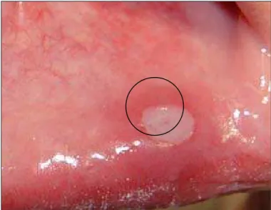 Figura 4.1 - Esquema da localização da biópsia na lesão ulcerada com punch de 5 mm 