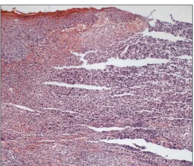 Figura 5.1 - Corte histológico da UAR (10x), evidenciando processo inflamatório crônico inespecífico  com ulceração 