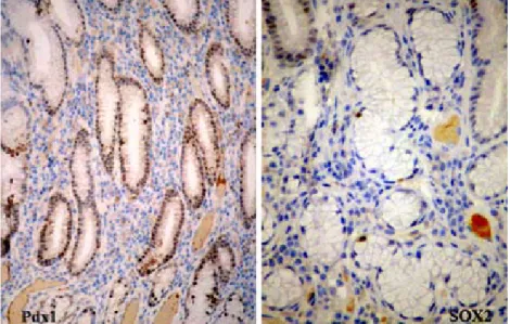Figura 6 – Cortes histológicos de mucosa gástrica normal: marcação nuclear focal de células  mucopepticas e foveolares com anti - Pdx1 e marcação focal de núcleos de células epiteliais  mucopepticas com anti - SOX2.