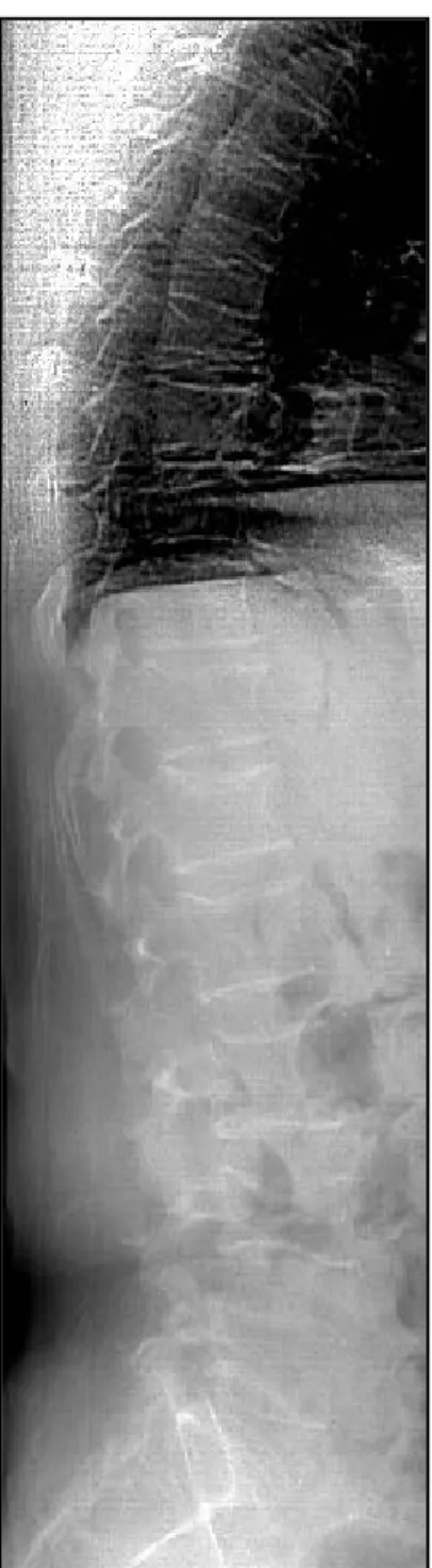 Figura  6-  Imagem  da coluna vertebral em projeção lateral  (DXA)  para  avaliação  visual  de deformidades  e realização da morfometria  (Técnica  VFA) 