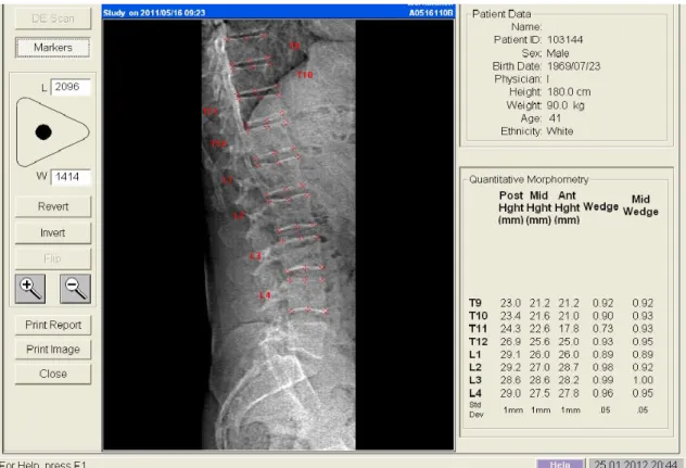 Figura 8- VFA de um homem de 41 anos com fractura de T11 em cunha,  grau 2 (moderado)