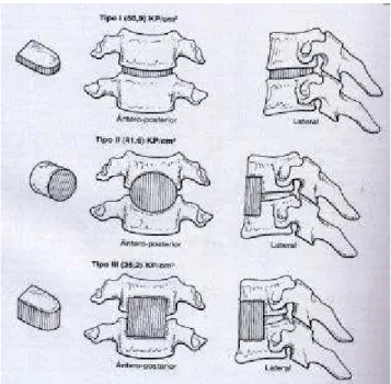 Fig. 4.1- Tipos de enxertos utilizados na artrodese anterior da coluna vertebral cervical