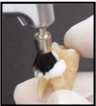 Figura  4.1-  Raspagem  com  curetas  periodontais                Figura  4.2-  Profilaxia  com  pedra  pomes  e  água 