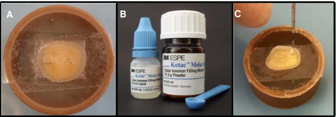 Figura  4.6-  A:  matriz  de  silicone  adaptada  na  superfície  de  dentina;  B:  CIV  utilizado:  Ketac  Molar  Easymix  –  3M- 3M-ESPE; C: Inserção do CIV na matriz; D: Proteção da superfície do CIV com verniz ácido resistente; E: 