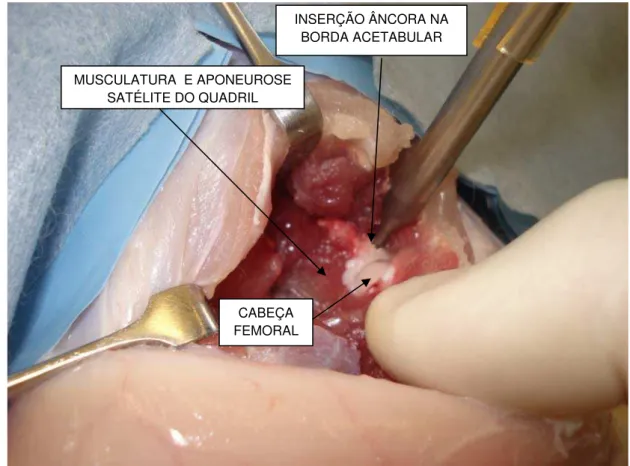 Figura 4 -   Capsulorrafia com âncora de titânio IKARIOS®-Ortocir de 2,0  mm de diâmetro  INSERÇÃO ÂNCORA NA BORDA ACETABULAR CABEÇA FEMORAL MUSCULATURA  E APONEUROSE SATÉLITE DO QUADRIL