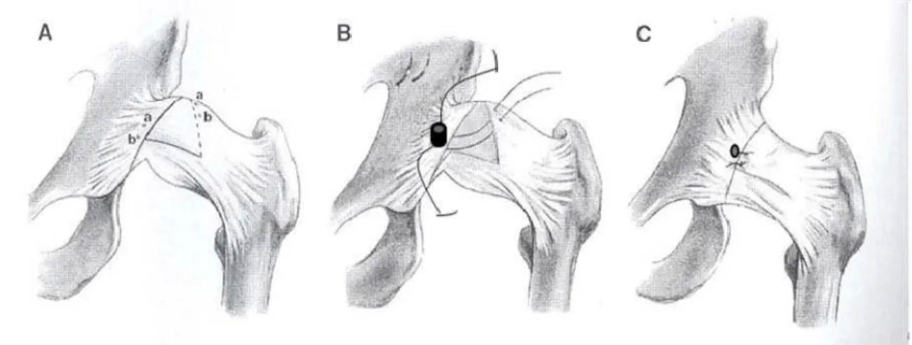 Figura 5 -   Ilustração  da inserção da âncora na borda acetabular e a  capsulorrafia 