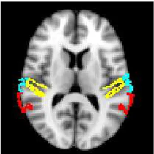 Figura  5  -  Máscara  do  córtex  auditivo  contruída  anatomicamente  a  partir  das  áreas  de  Brodmann  41  (amarelo), 42 (azul) e 22 (vermelho)