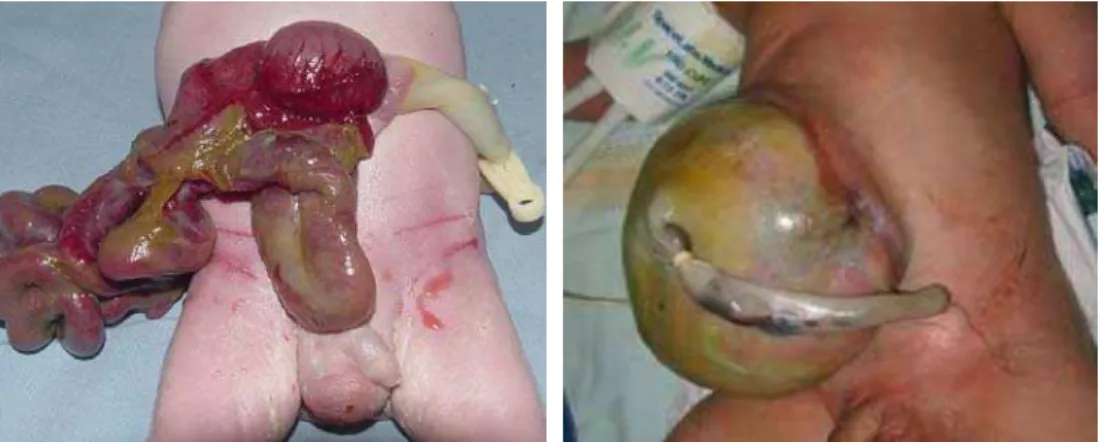 Figura 9 -   À esquerda, recém-nascido com gastrosquise, com conteúdo  exteriorizado livre e cordão umbilical inserido na parede abdominal e à  direita da abertura