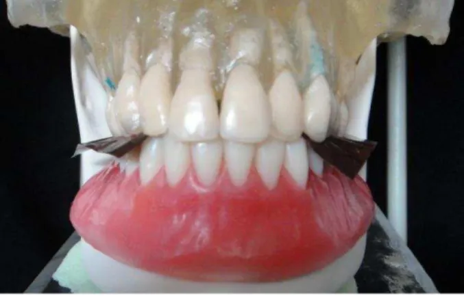 Figura 4.14 - Interposição do carbono accufilm ®  entre a maxila e plano com montagem de dentes 