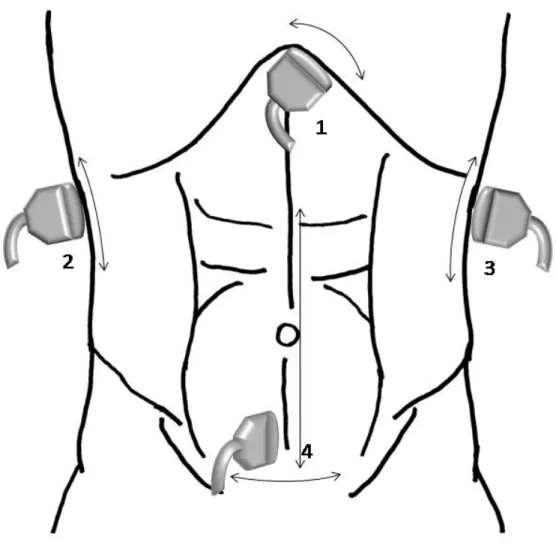 Figura 2 - Protocolo de quatro quadrantes do FAST compreendendo janela pericárdica (1),  espaço hepatorrenal (2), espaço esplenorrenal (3) e pelve (4)