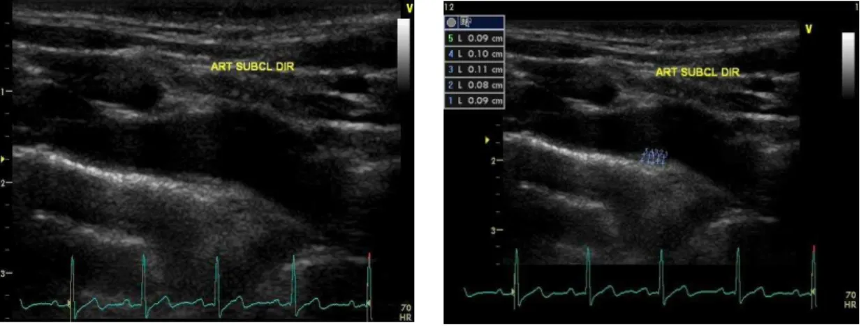 Figura  6  -  (a)  Origem  da  artéria  subclávia  direita  e  (b)  Medida  da  EMI  na  artéria subclávia direita