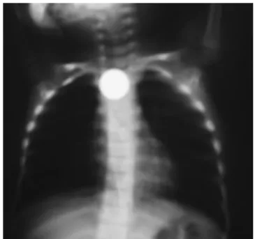 Figura 5. Moeda alojada no  esófago superior de uma  criança. 15