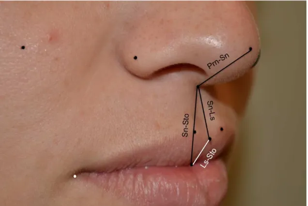 Figura  15  -  Esquema  de  distâncias  lineares  realizadas:  aspecto  fronto-lateral  aproximado da região de nariz e boca