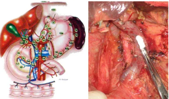 Figura 1 Linfonodos peri-pancreáticos e retro-peritoneais (esq.) 