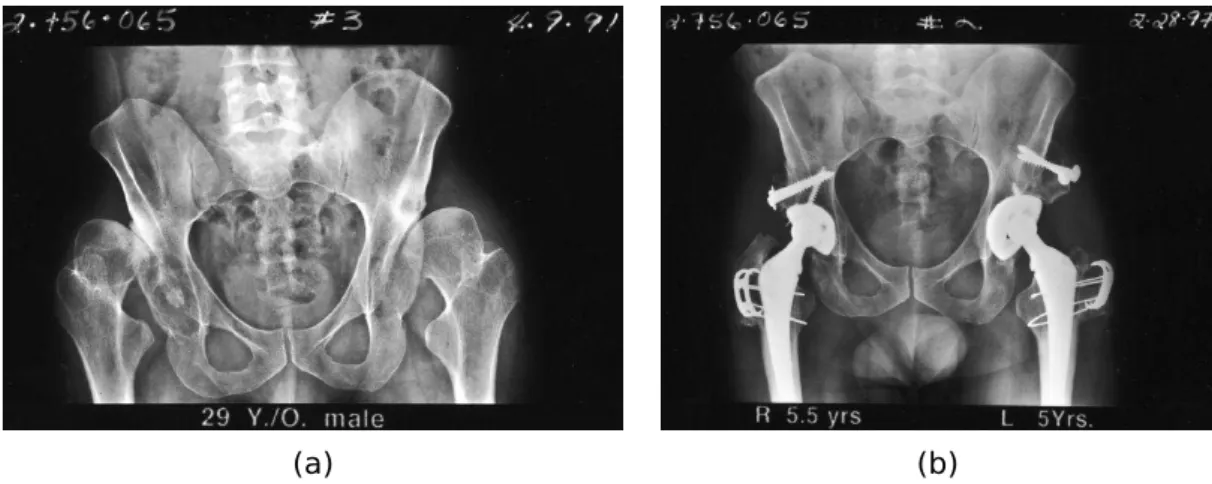 Figura 1.2: Radiograﬁas pélvicas AP de um homem de 29 anos (a) com displasia do quadril e (b) após artroplastia total de quadril de ambos os lados do quadril