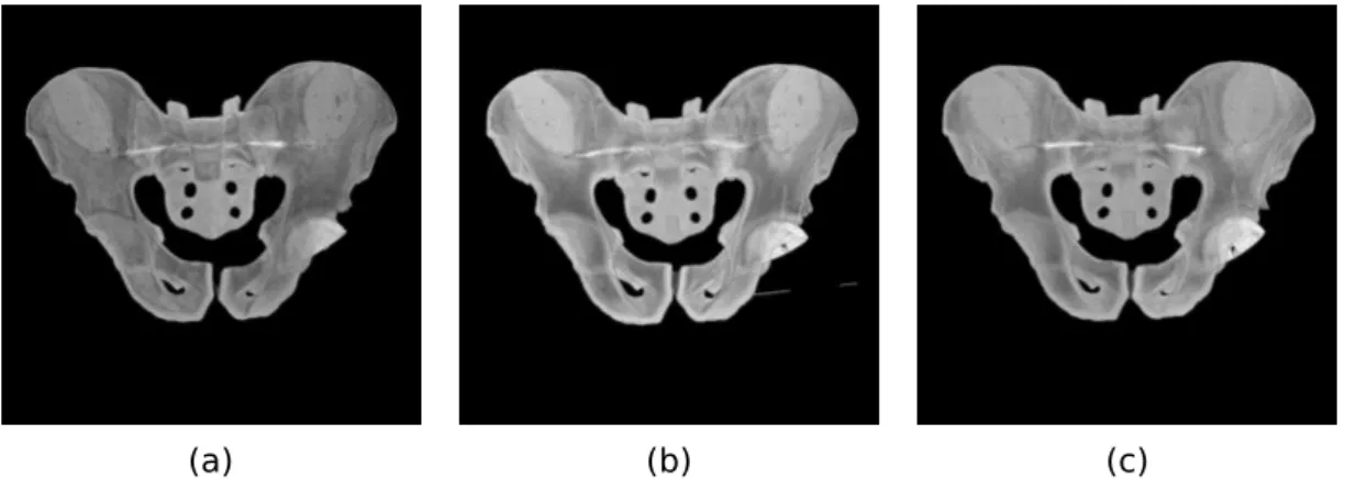 Figura 1.3: Radiograﬁas AP (anteroposterior) de modelos pélvicos, simulando diferentes coberturas de componentes acetabulares em artroplastia total de quadril.