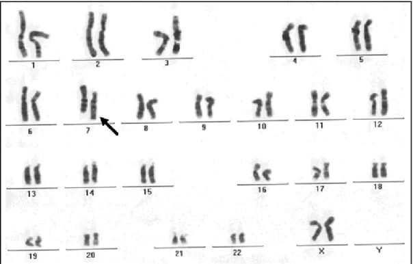 Figura 21 – Cariótipo 46,XX,inv(7)(p13;q36), a seta indica o cromossomo 7, da genitora, com  a inversão 