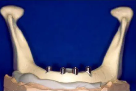 Figura 4.2 - Análogos de implantes simulando um caso clínico que receberia uma prótese clássica de  Brånemark 