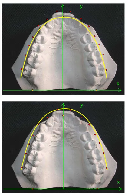 Figura 4.18 - Distância entre os pontos médios virtuais das faces vestibulares  (pontos vermelhos) e a curvatura deslocada do rebordo alveolar 