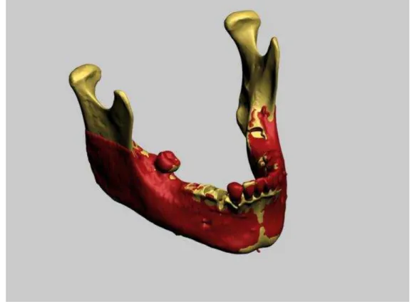 Figura 4.14 - Alinhamento virtual entre o “padrão ouro” e o modelo obtido pelo tomógrafo NEWTOM    9000 DVT 