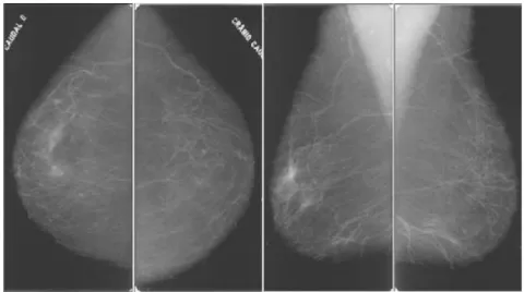 Figura 1.1: As duas imagens de cada uma das mamas que comp˜oem um exame de mamografia
