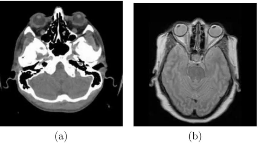 Figura 2.7: Exemplos de imagens m´edicas digitais de cabe¸ca. (a) Imagem de tomografia computadorizada