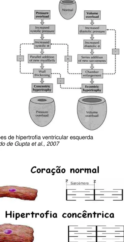 Figura 1: Padrões de hipertrofia ventricular esquerda   Fonte: modificado de Gupta et al., 2007 