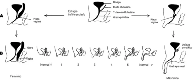 Figura 2. A: Diferenciação normal da genitália feminina. B: Representação esquemática dos  diferentes graus de virilização fetal da genitália feminina, quantificação usando a escala de Prader (I  a V)