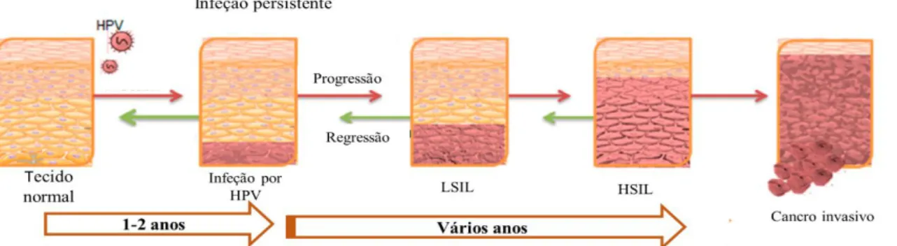 Figura  1.  5:  Evolução  da  infeção  nas  células  do  epitélio  escamoso  provocada  pelo  papiloma  vírus humano (HPV)