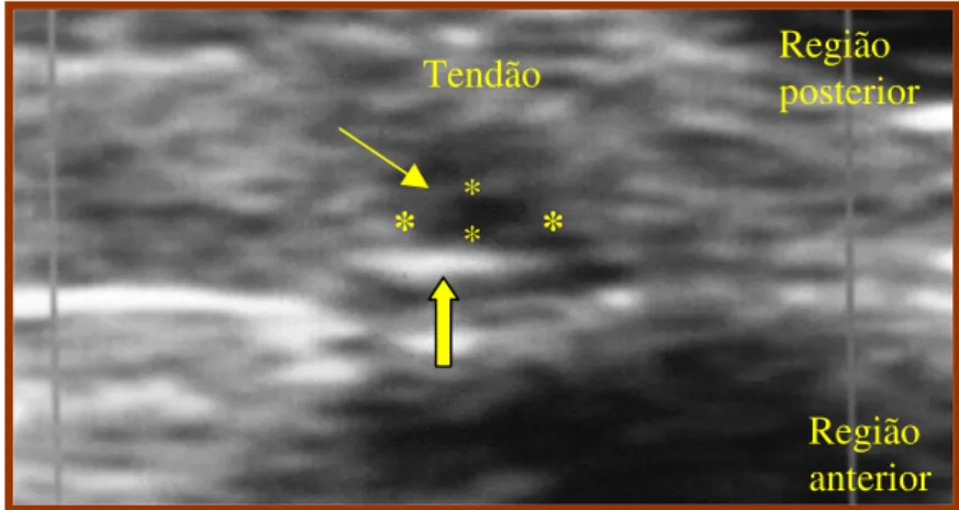 FIGURA 7: Equipamento Laser utilizado no experimento  FIGURA 6: Imagem de Ultrassonografia do tendão calcâneo de rato após lesão com queda de 186 g à uma altura de 20 cm em estudo piloto.(seta estreita = local de lesão, seta larga = osso adjacente)